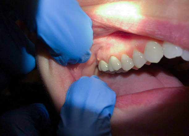 Best Tooth Infection Emergency Dentist  in Lexington Hills, CA